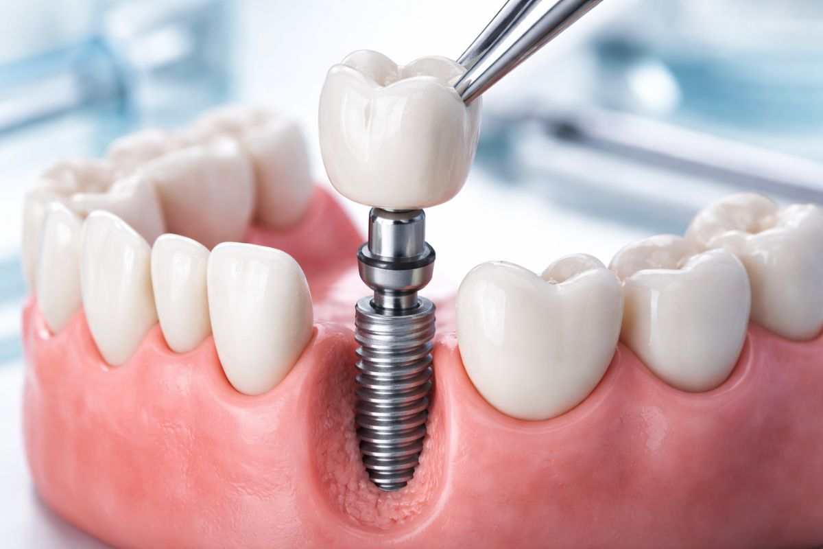 Dental implant procedure close up