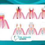 الفرق بين حشو العصب والعادي