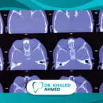 سرطان الفك يظهر كتورم في عظام الفك مع أعراض مثل الألم وصعوبة المضغ