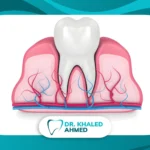 تركيب عصب الأسنان داخل الجذر مع الأعصاب والأوعية الدموية