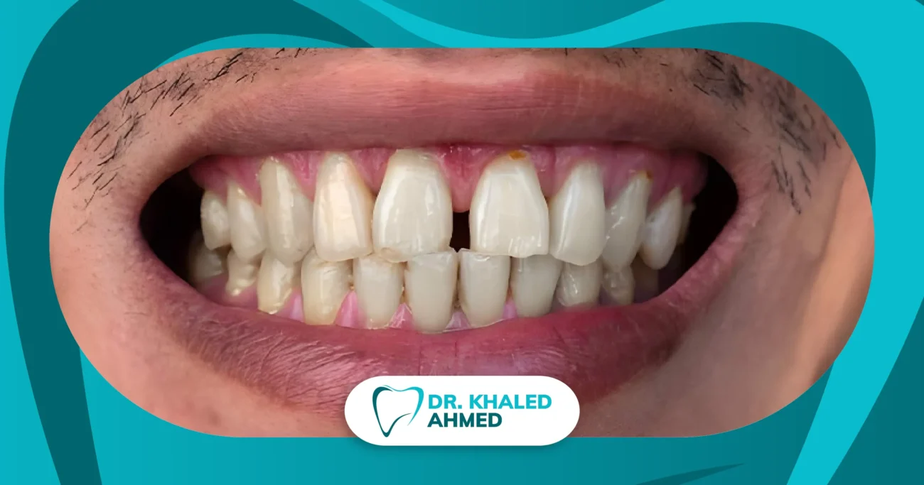 علاج الفراغات بين الأسنان