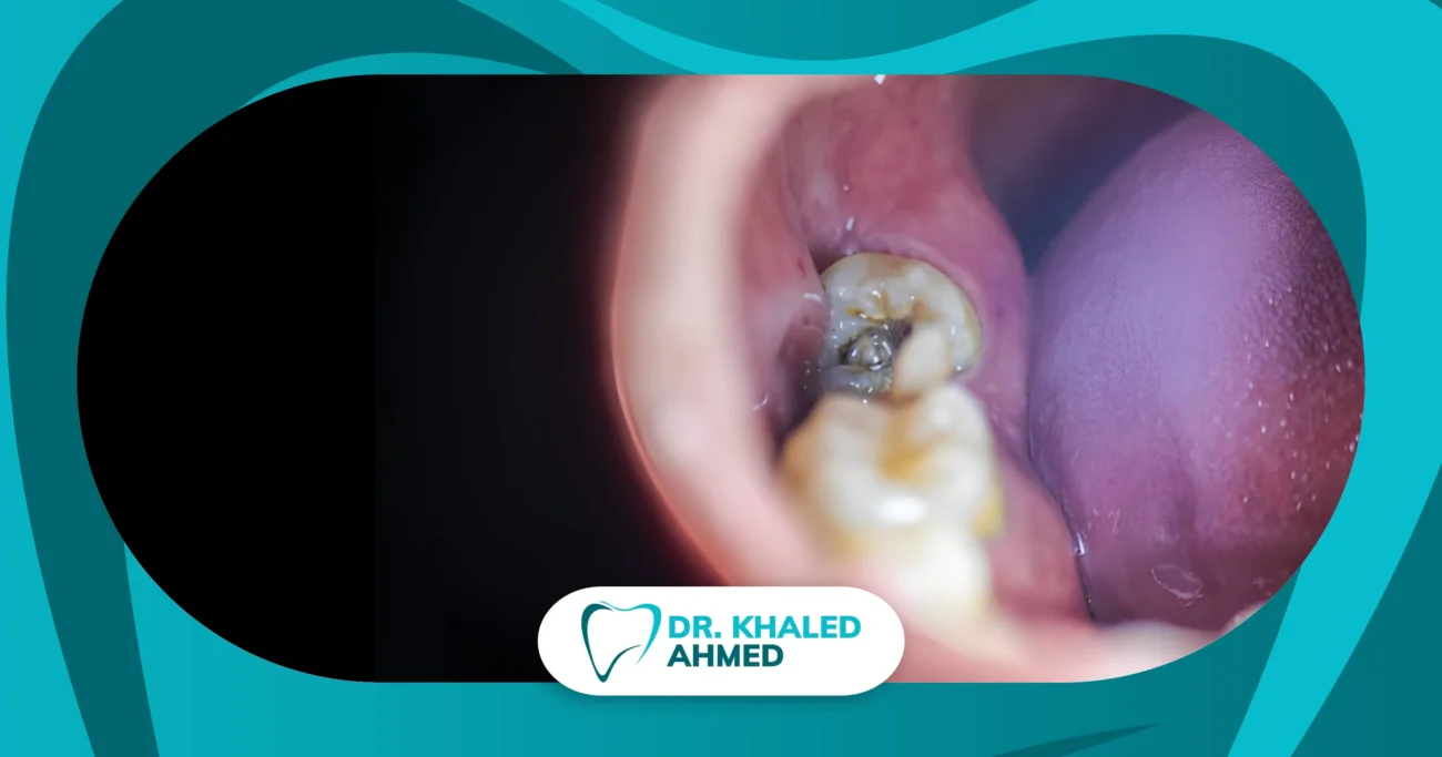 زائدة لحمية ضرس العقل