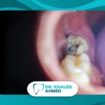 زائدة لحمية ضرس العقل