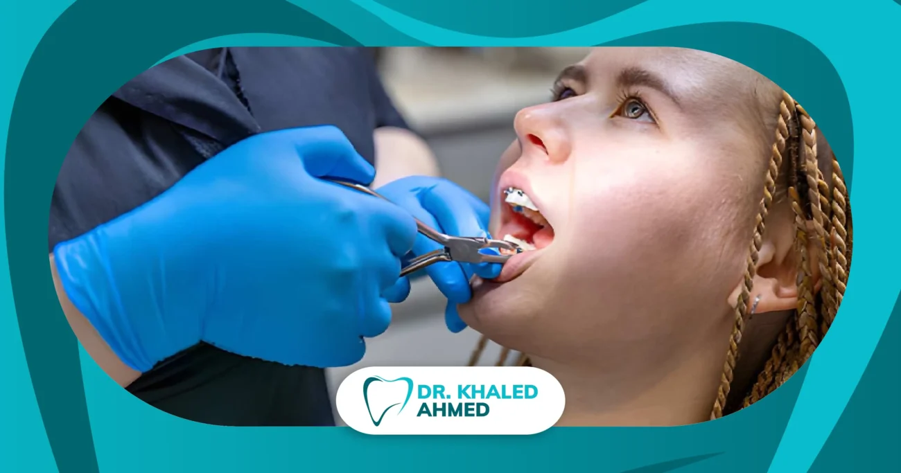 خلع الأسنان أثناء التقويم لعلاج تزاحم الأسنان وتحسين اصطفافها والحصول على ابتسامة متناسقة