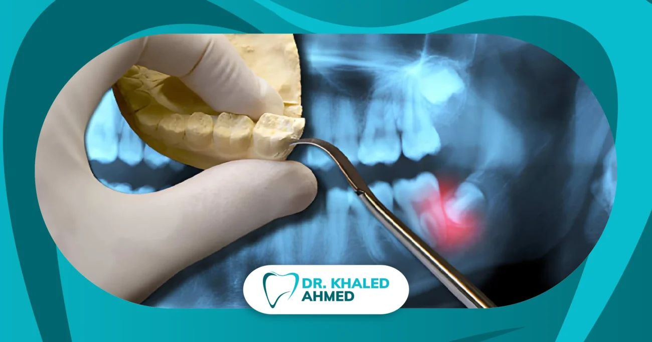 خلع ضرس العقل بواسطة طبيب أسنان متخصص لعلاج الألم والتهابات الفك