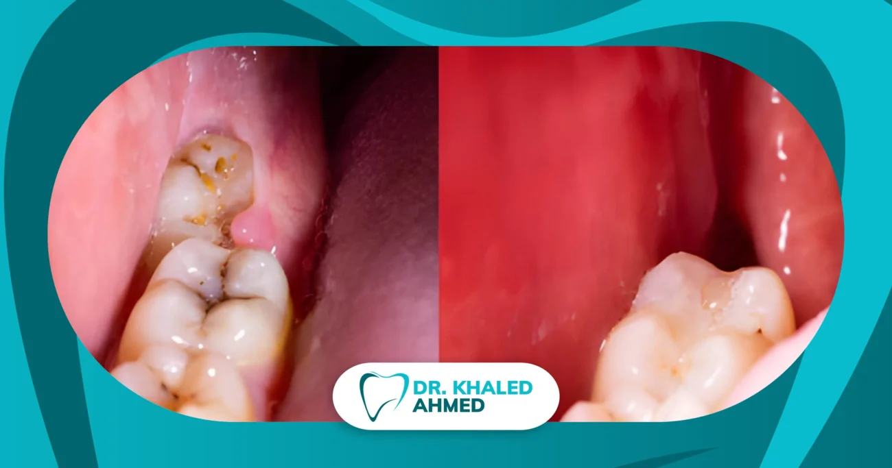 خلع ضرس عقل مدفون جراحيًا داخل عيادة الأسنان باستخدام أحدث التقنيات لعلاج ضروس العقل المدفونة