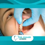 تكلفة خلع ضرس العقل الجراحي تعتمد على حالة الضرس ومدى صعوبة الجراحة وخبرة طبيب الأسنان.