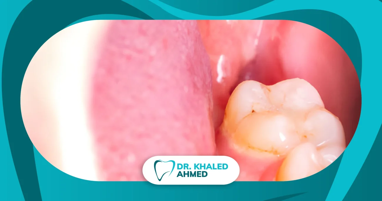 شكل اللثة بعد خلع ضرس العقل أثناء مرحلة الالتئام الطبيعية وظهور تجويف مكان الضرس المخلوع